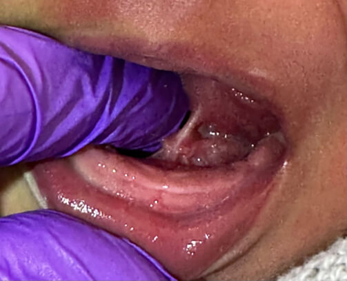 Mother's Journey tongue tie South London