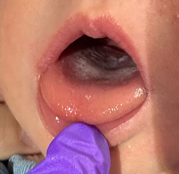 Mother's Journey tongue tie South London support areas